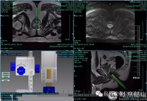 精准医疗在泌尿外科的应用---前列腺癌精准穿刺活检