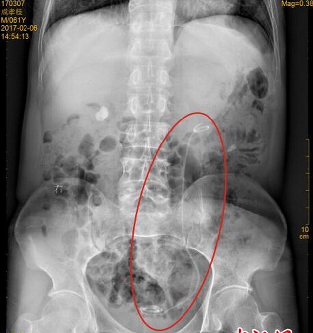 男子体内现导管 30厘米的医用导管存留体内7年已变黑色