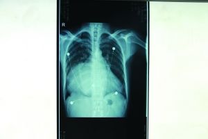 X光片显示巨大心脏填满了整个胸腔院方供图