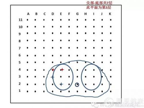 精准医疗在泌尿外科的应用---前列腺癌精准穿刺活检