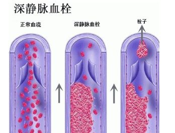 下肢深静脉血栓护理