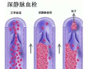 下肢深静脉血栓护理方法有哪些？这些可不能忽视