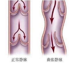 下肢静脉血栓症状