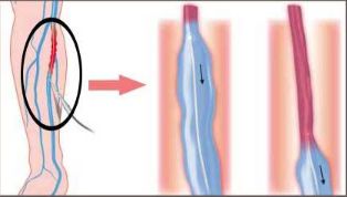 静脉曲张怎么治