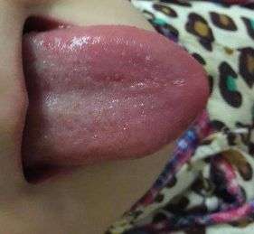 宝宝地图舌怎么治疗，想治好还是要用它