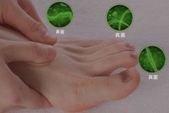 甲沟炎灰指甲脚气，这些病症你会区别吗？