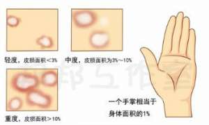 治疗银屑病最简单的药有吗，效果怎么样？