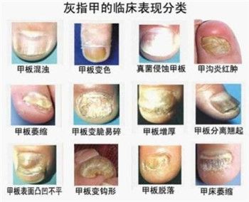 灰指甲与甲沟炎怎么鉴别？方法在这里