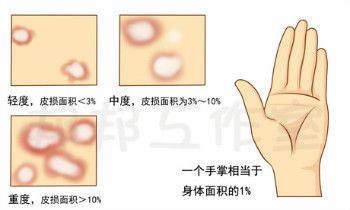 银屑病具有哪些病理特征？记准了好分辨