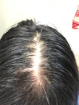 怎样治疗脱发和生发？用了达霏欣米诺地尔三个月长出了头发是真得吗？