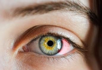 眼睛结膜炎该怎么办？这里有应对方法