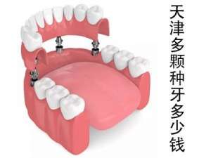 天津半口种植牙的费用多少钱