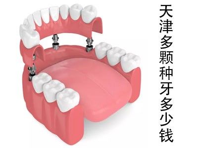 天津半口种植牙的费用多少钱