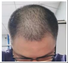 如何进行男性雄激素性脱发治疗？用我的亲身经历告诉你