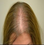 女性脂溢性脱发治疗方法有哪些？生发有道，换发“欣”生！