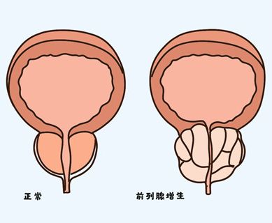 高血压伴前列腺增生吃什么药？保护男性健康用它没错！