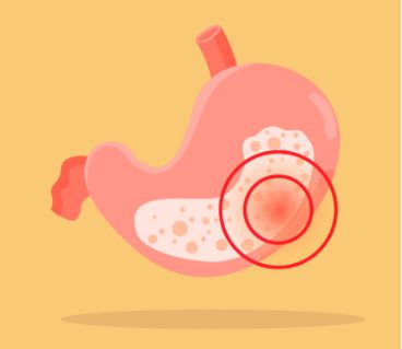 蒙脱石散能治疗急性肠胃炎吗？如何远离急性肠胃炎？