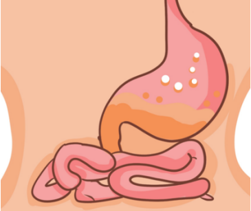 胃溃疡能喝蒙脱石散么？这些都要注意