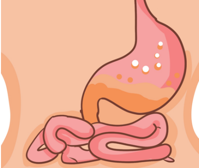 蒙脱石散可以用于胃溃疡吗？胃溃疡治疗有讲究